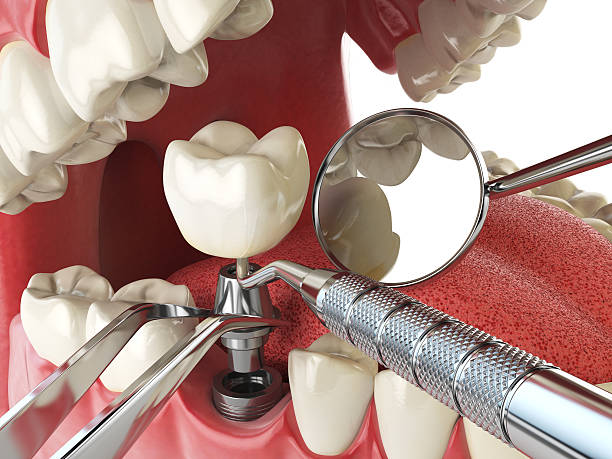 Best Emergency Dental Care for Broken or Chipped Teeth in Columbus, GA